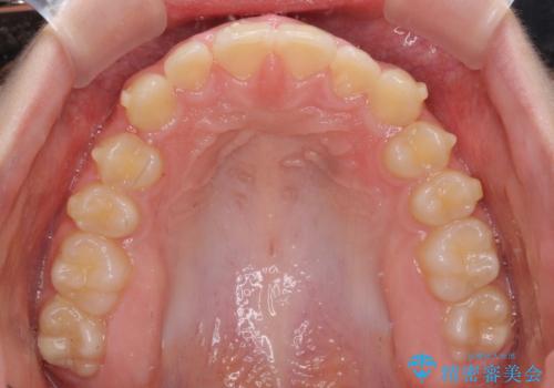 海外で始めたインビザライン 転医手続きにより治療を継続の治療前