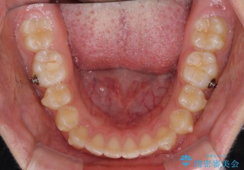 海外で始めたインビザライン 転医手続きにより治療を継続の治療前