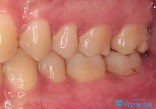 度重なる処置でつぎはぎだらけ オールセラミッククラウンによる補綴治療の治療前