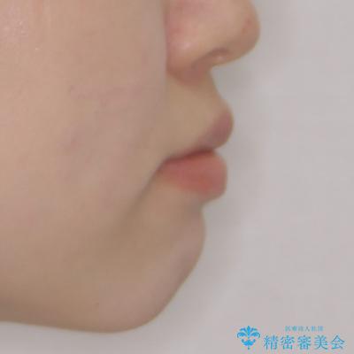 ワイヤー装置の抜歯矯正で横顔のシルエットをすっきりとの治療前(顔貌)
