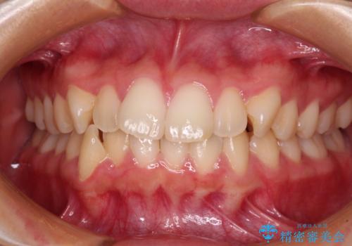 ワイヤー装置の抜歯矯正で横顔のシルエットをすっきりとの症例 治療前