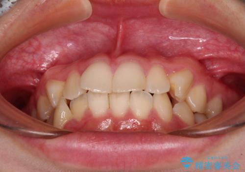 ワイヤー装置の抜歯矯正で横顔のシルエットをすっきりとの治療前