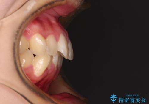 ワイヤー装置の抜歯矯正で横顔のシルエットをすっきりとの治療前
