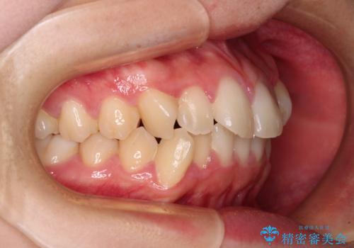 ワイヤー装置の抜歯矯正で横顔のシルエットをすっきりとの治療前