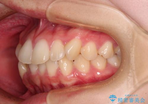 ワイヤー装置の抜歯矯正で横顔のシルエットをすっきりとの治療前