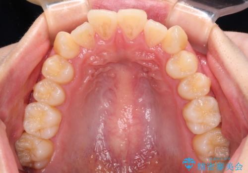 ワイヤー装置の抜歯矯正で横顔のシルエットをすっきりとの治療前