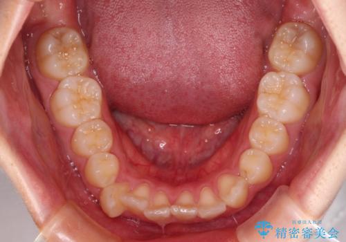 ワイヤー装置の抜歯矯正で横顔のシルエットをすっきりとの治療前