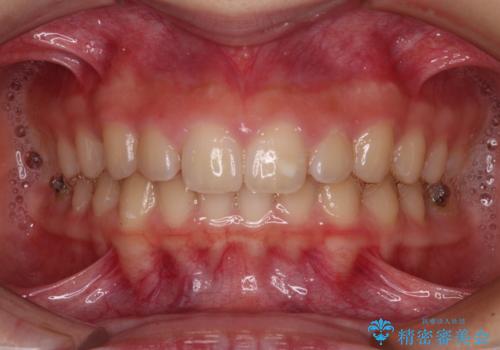 海外で始めたインビザライン 転医手続きにより治療を継続の治療中