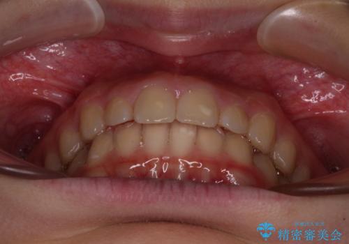 海外で始めたインビザライン 転医手続きにより治療を継続の治療中