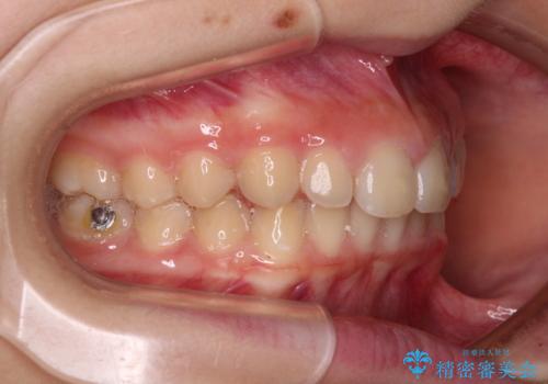 海外で始めたインビザライン 転医手続きにより治療を継続の治療中