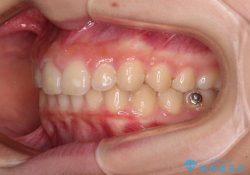 海外で始めたインビザライン 転医手続きにより治療を継続の治療中