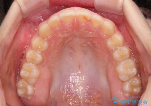 海外で始めたインビザライン 転医手続きにより治療を継続の治療中