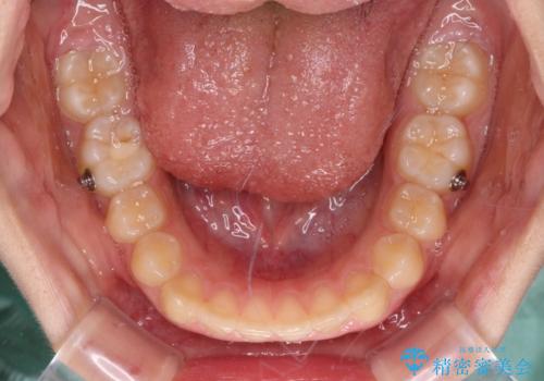 海外で始めたインビザライン 転医手続きにより治療を継続の治療中