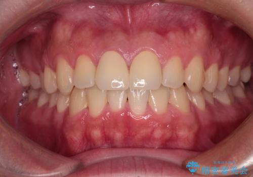 酔っ払ってぶつけた前歯 オールセラミッククラウンで自然な前歯にの治療後