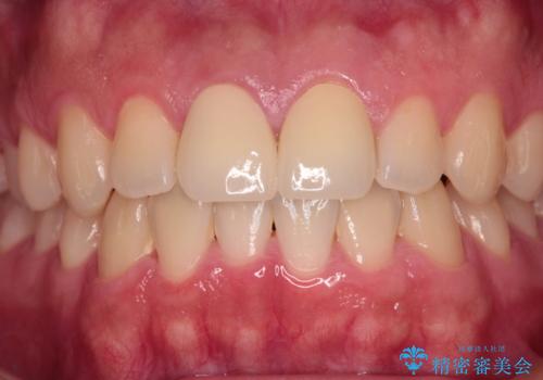 酔っ払ってぶつけた前歯 オールセラミッククラウンで自然な前歯にの治療後