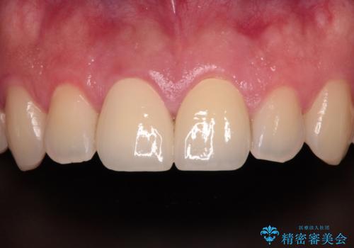 酔っ払ってぶつけた前歯 オールセラミッククラウンで自然な前歯にの症例 治療後