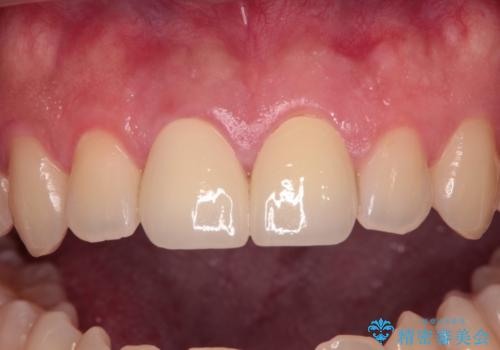 酔っ払ってぶつけた前歯 オールセラミッククラウンで自然な前歯にの治療後