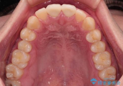 酔っ払ってぶつけた前歯 オールセラミッククラウンで自然な前歯にの治療後