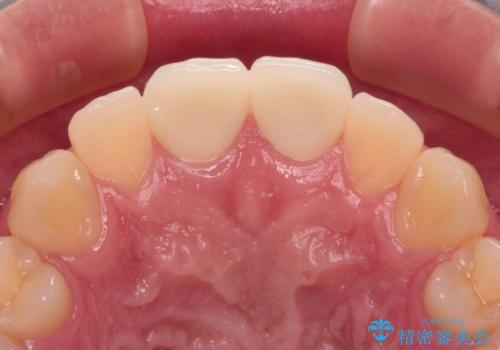 酔っ払ってぶつけた前歯 オールセラミッククラウンで自然な前歯にの治療後