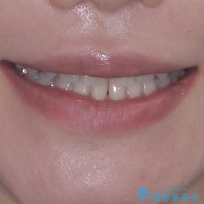 前歯のデコボコをすっきりと　インビザライン矯正の治療後（顔貌）