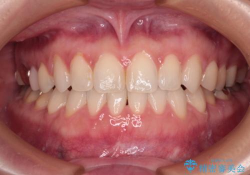 前歯のデコボコをすっきりと インビザライン矯正の症例 治療後