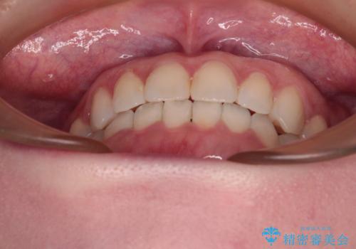 前歯のデコボコをすっきりと インビザライン矯正の治療後