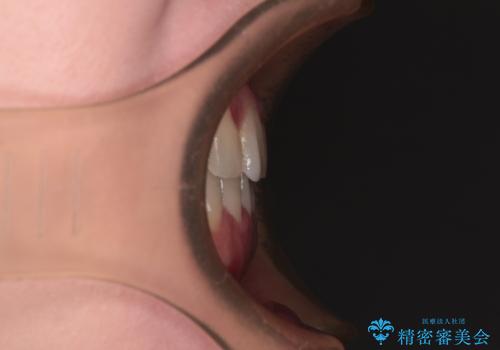 前歯のデコボコをすっきりと インビザライン矯正の治療後