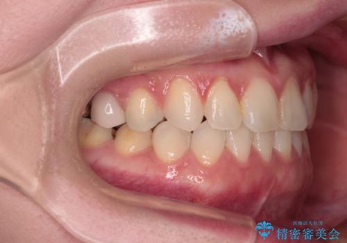 前歯のデコボコをすっきりと インビザライン矯正の治療後