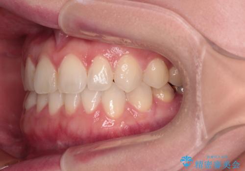 前歯のデコボコをすっきりと インビザライン矯正の治療後