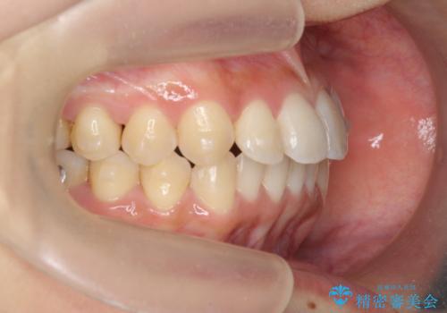 ワイヤー部分矯正治療を併用したマウスピース矯正治療の治療中