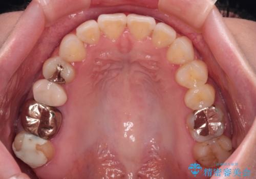 前歯のデコボコをすっきりと　インビザライン矯正の治療後