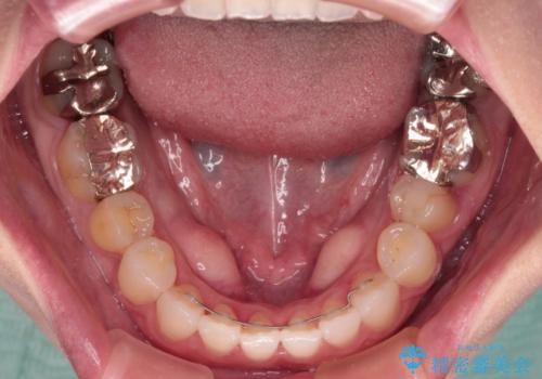 前歯のデコボコをすっきりと インビザライン矯正の治療後