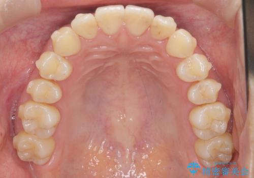 ワイヤー部分矯正治療を併用したマウスピース矯正治療の治療中