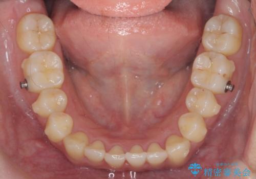 ワイヤー部分矯正治療を併用したマウスピース矯正治療の治療中