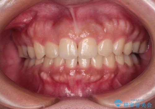 急速拡大とワイヤー抜歯矯正で唇を閉じやすくの症例 治療後