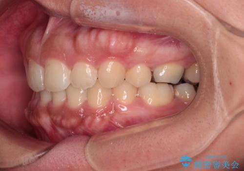 急速拡大とワイヤー抜歯矯正で唇を閉じやすくの治療後