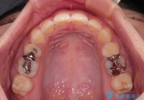 急速拡大とワイヤー抜歯矯正で唇を閉じやすくの治療後