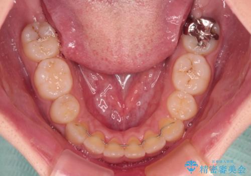 急速拡大とワイヤー抜歯矯正で唇を閉じやすくの治療後