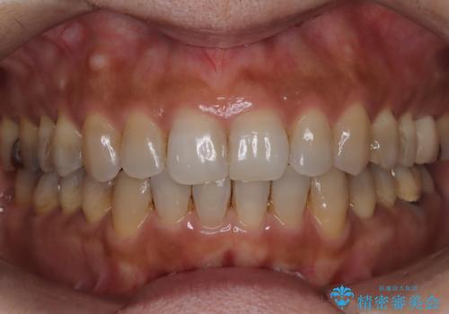 インビザラインで自然な美しさへ、前歯のガタツキを改善しましたの症例 治療後