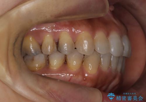 インビザラインで自然な美しさへ、前歯のガタツキを改善しましたの治療後