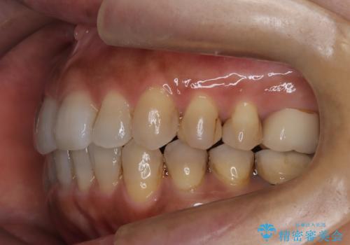 インビザラインで自然な美しさへ、前歯のガタツキを改善しましたの治療後