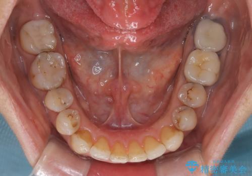 インビザラインで自然な美しさへ、前歯のガタツキを改善しましたの治療後