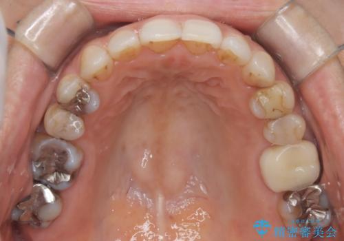 インビザラインで自然な美しさへ、前歯のガタツキを改善しましたの治療後