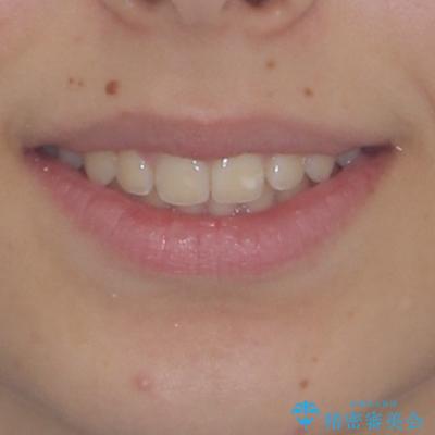 海外で始めたインビザライン 転医手続きにより治療を継続の治療後(顔貌)