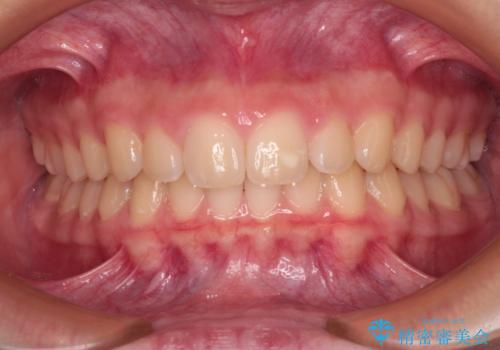 海外で始めたインビザライン 転医手続きにより治療を継続の症例 治療後