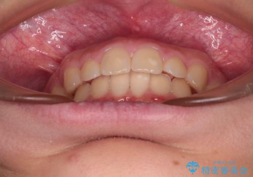 海外で始めたインビザライン 転医手続きにより治療を継続の治療後