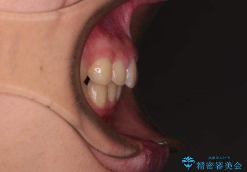 海外で始めたインビザライン 転医手続きにより治療を継続の治療後