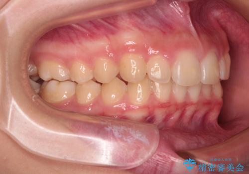 海外で始めたインビザライン 転医手続きにより治療を継続の治療後