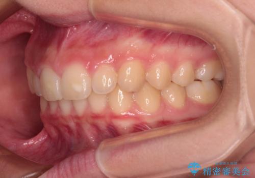 海外で始めたインビザライン 転医手続きにより治療を継続の治療後