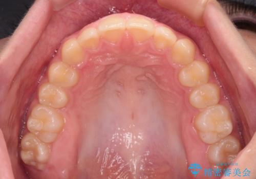 海外で始めたインビザライン 転医手続きにより治療を継続の治療後